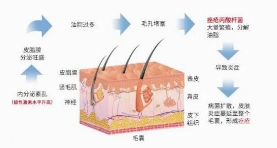 痤瘡,痤瘡丙酸桿菌,炎癥,毛囊皮脂